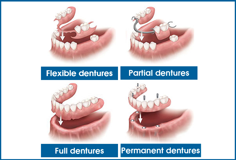 Types of same day dentures