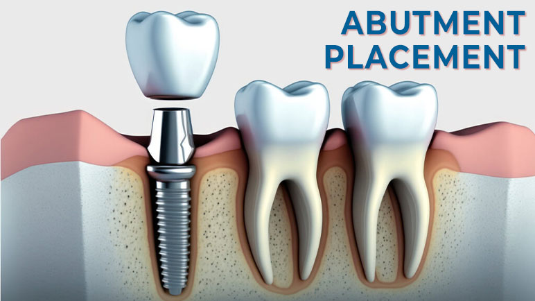 Phase 2: Abutment placement