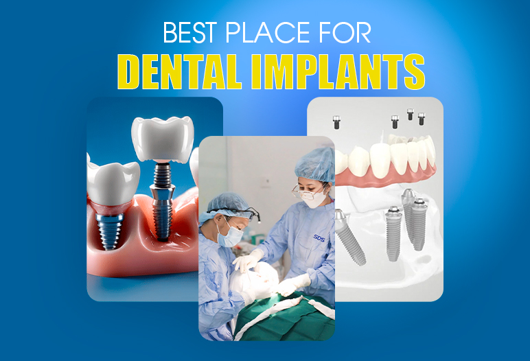 best place for dental implants near me​