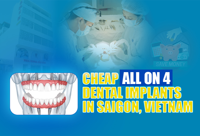 all on four dental implants price