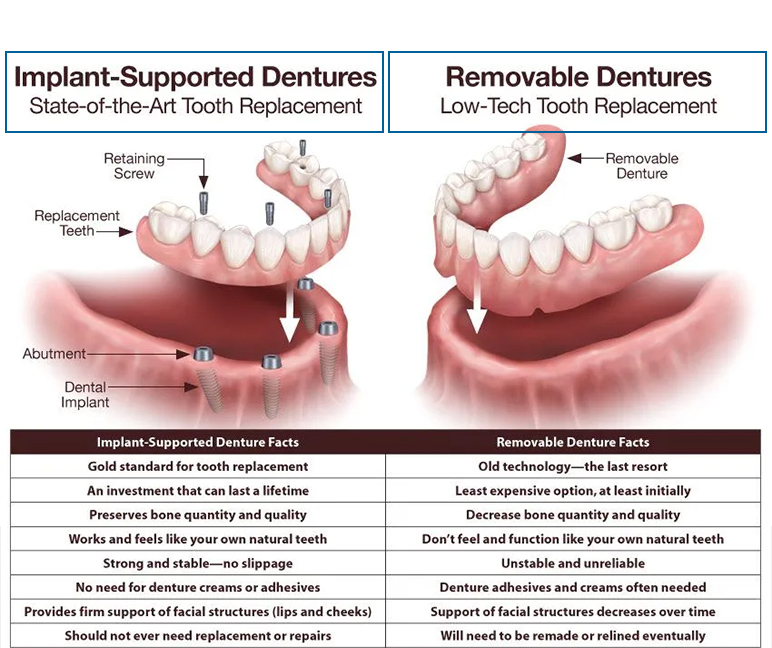 dental implants dentures vs dentures