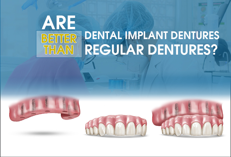 dental implant dentures