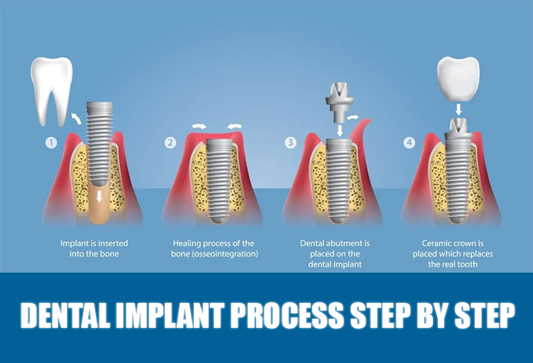 tooth implant procedure steps