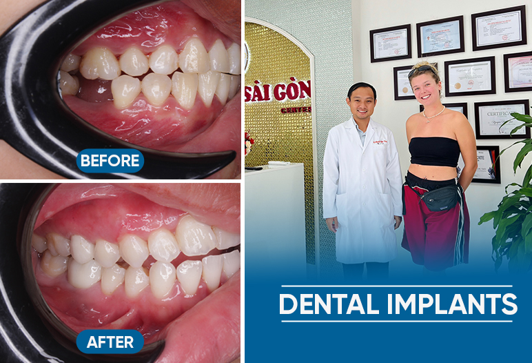 Results of dental implants