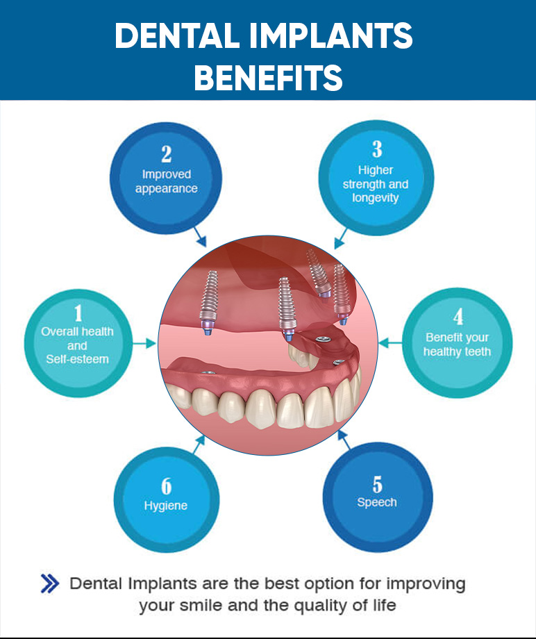 Dental Implants benefits