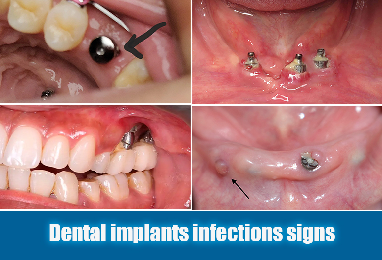 dental implant infection pictures