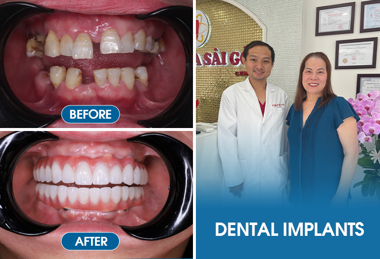 result of dental implants