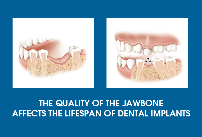 how long do tooth implants last