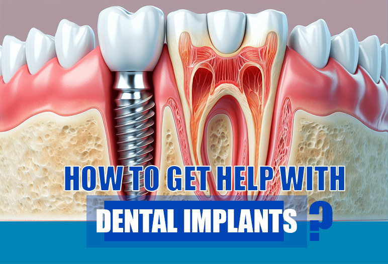 how to get full mouth dental implants for free