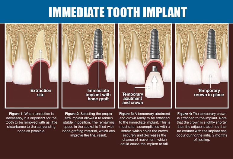 procedure of immediate tooth implant