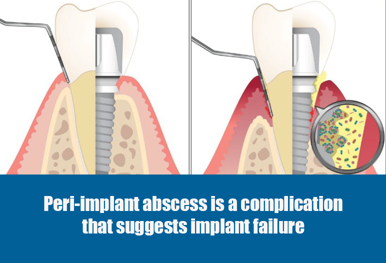 infected dental implant