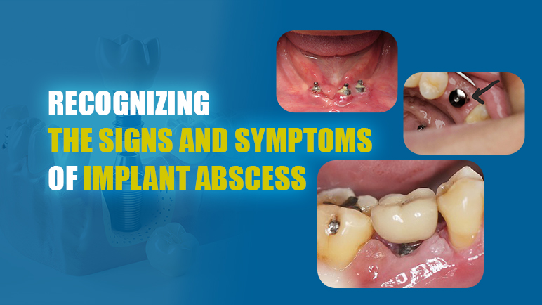 tooth implant how long does it last