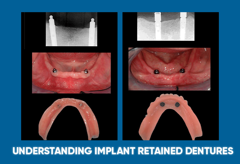 Understanding implant retained dentures