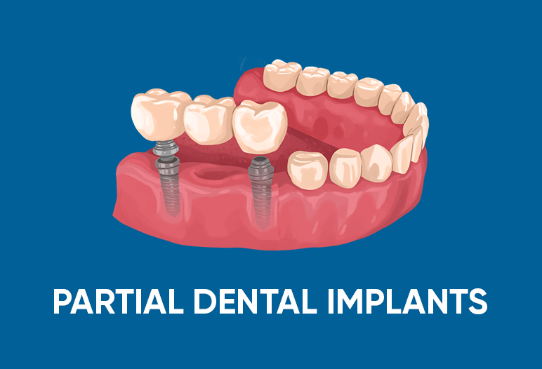 partial dental implants