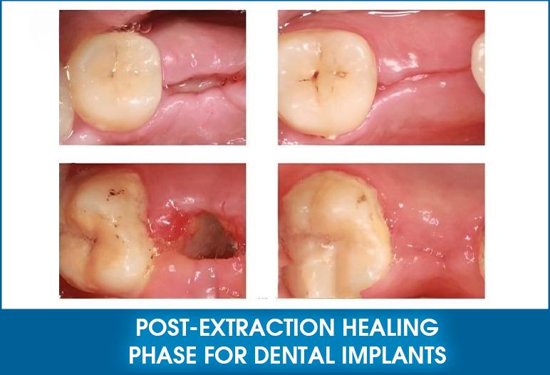 Post-extraction healing phase for dental implants