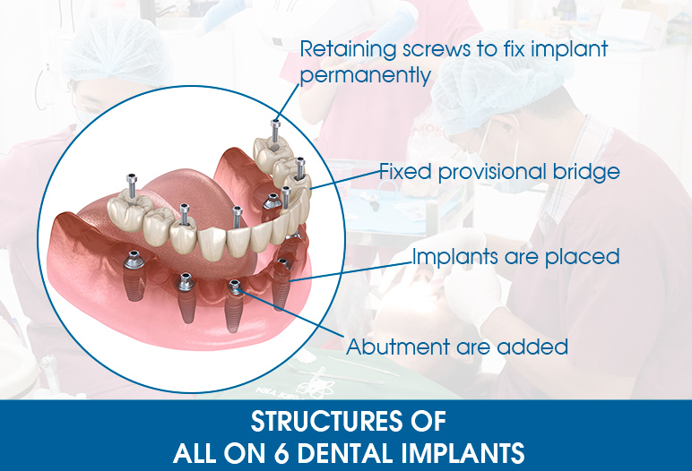 structures of all on 6 implants