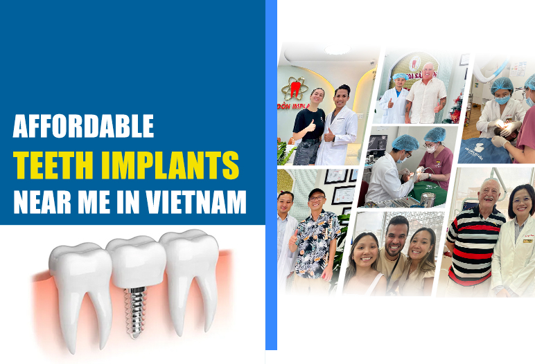 teeth implants near me