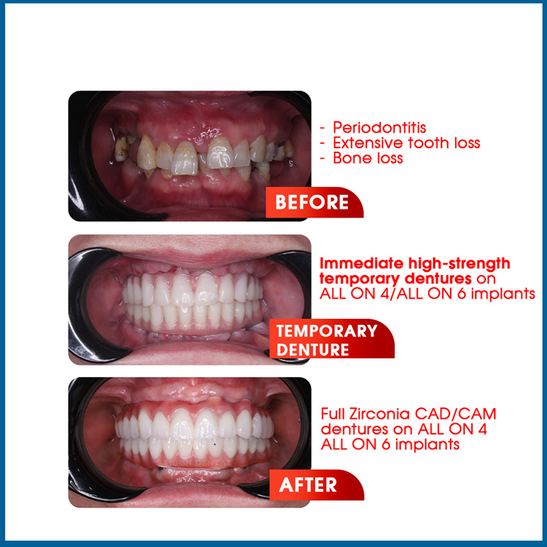 temporary tooth on implants