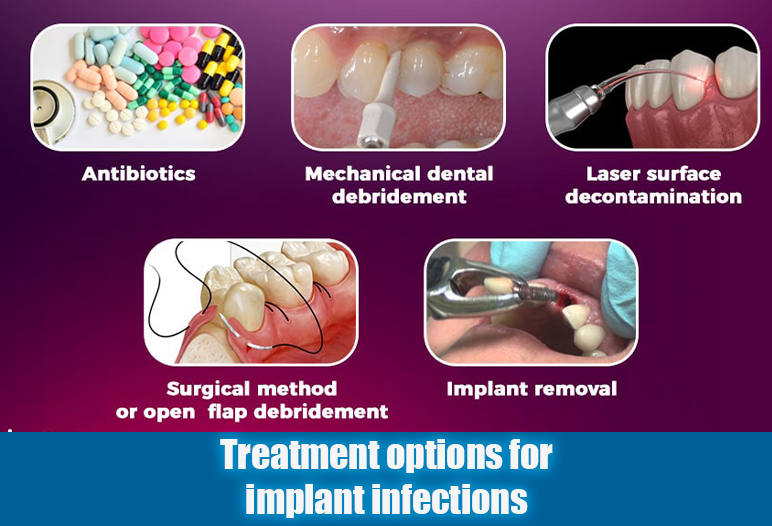 treatment of dental implant infection