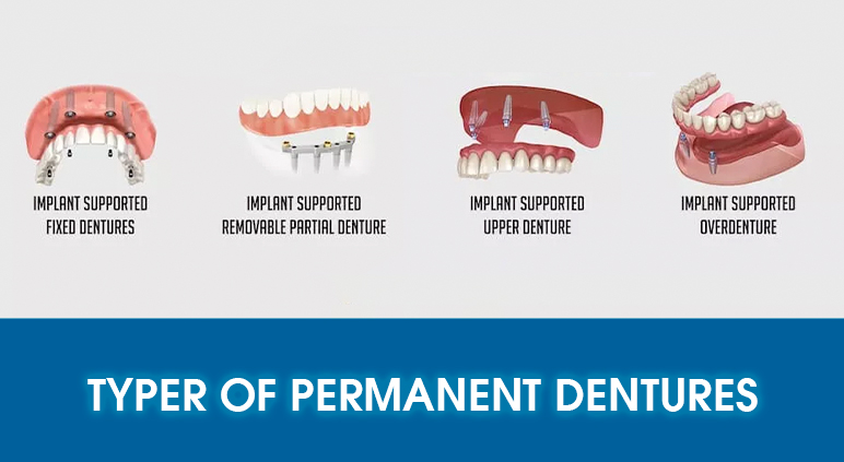 Types of Implant-Supported Dentures