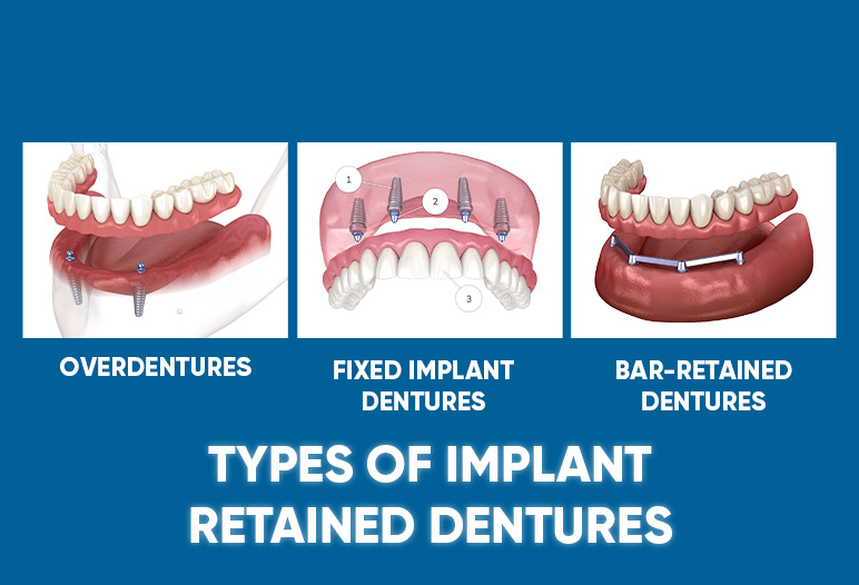 Types of implant retained dentures