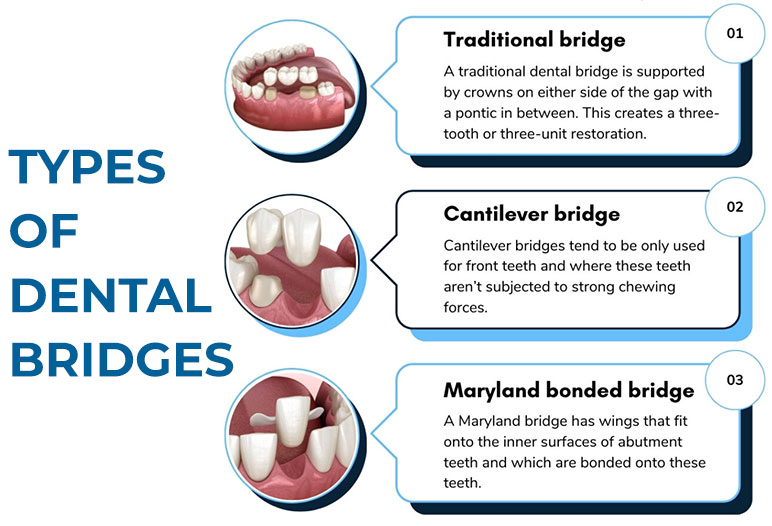 Types of dental bridges