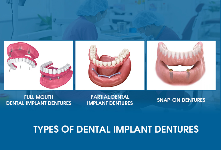 Types of Dental Implant Dentures