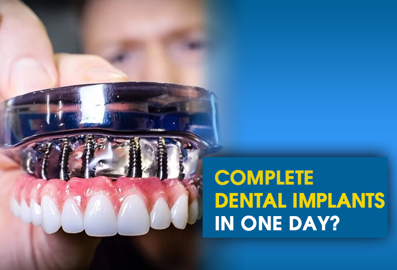 complete dental implants