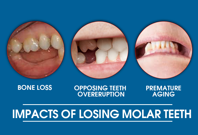 Impacts of losing molar teeth