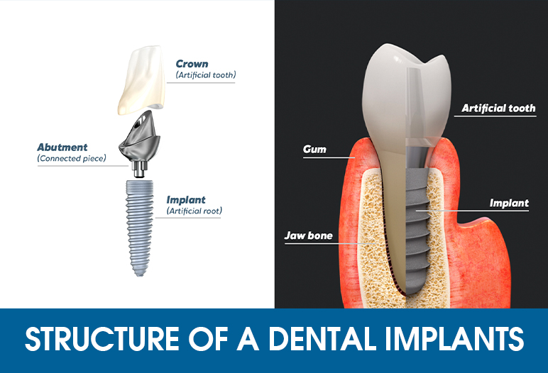 implant tooth