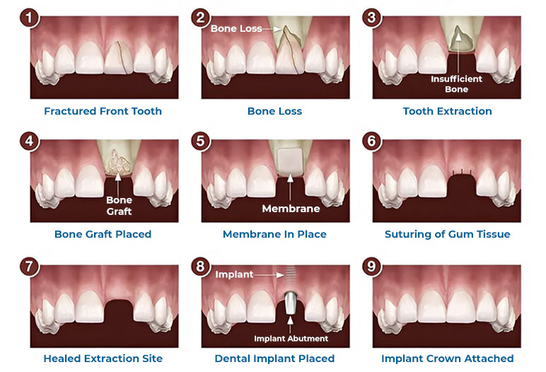 The bone grafting procedure