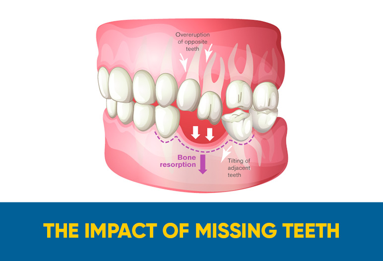 The impact of missing teeth