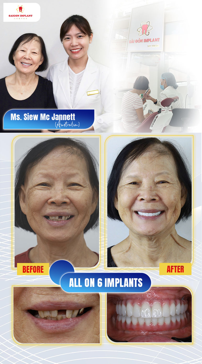 Dr. Nguyen Thi Bich Van restores a full arch with implant-supported porcelain crowns