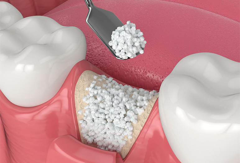 bone grafting