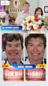 getting dental crowns in vietnam