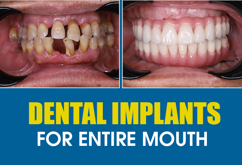 dental implants for entire mouth