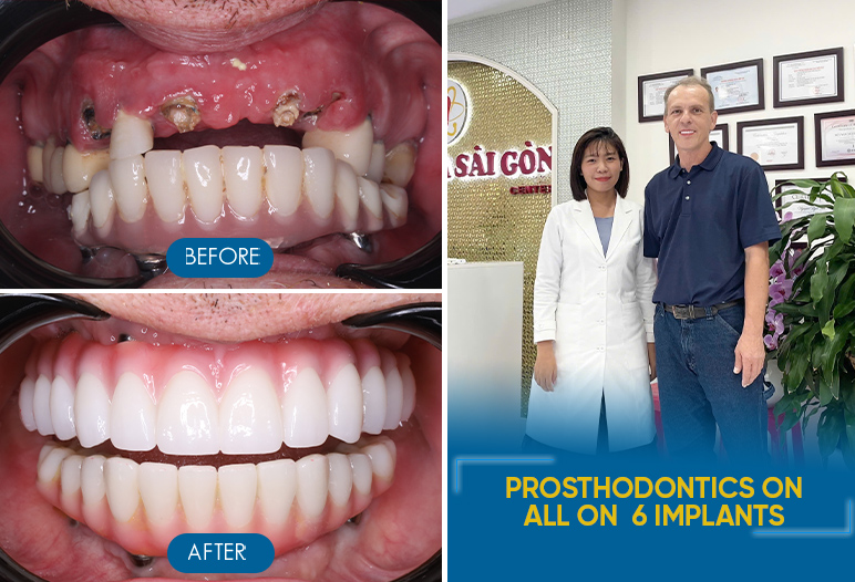 full upper denture with implants