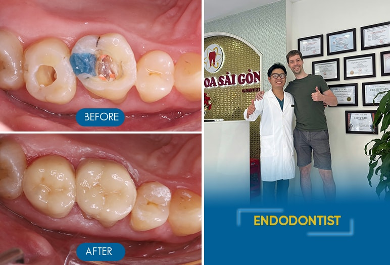 root canal treatment before after