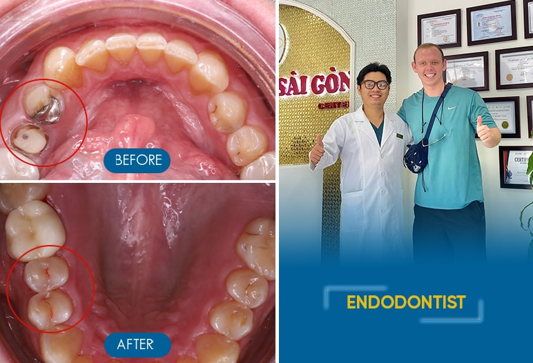 root canal treatment before after