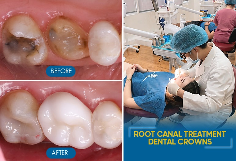 Root canal treatment and dental crowns