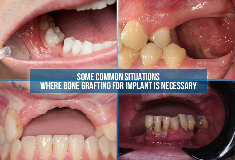 bone grafting for implant