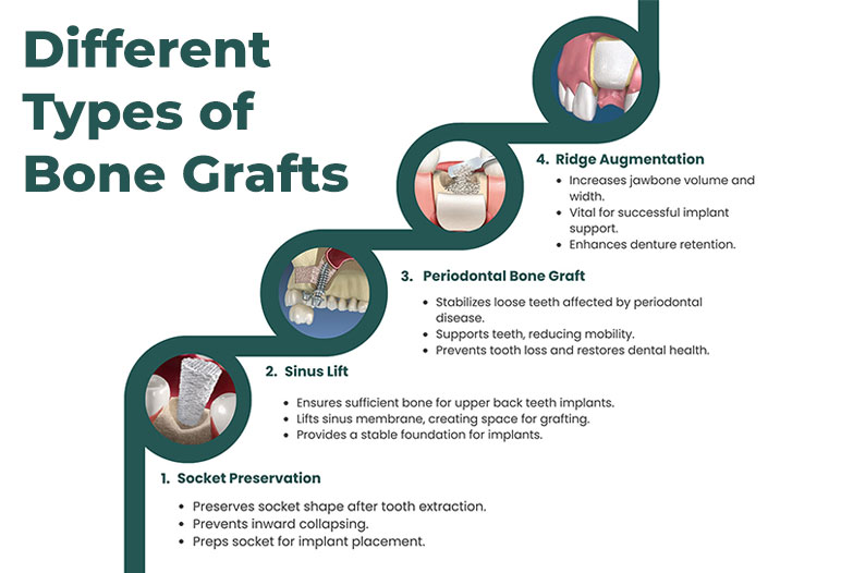 Types of bone grafts