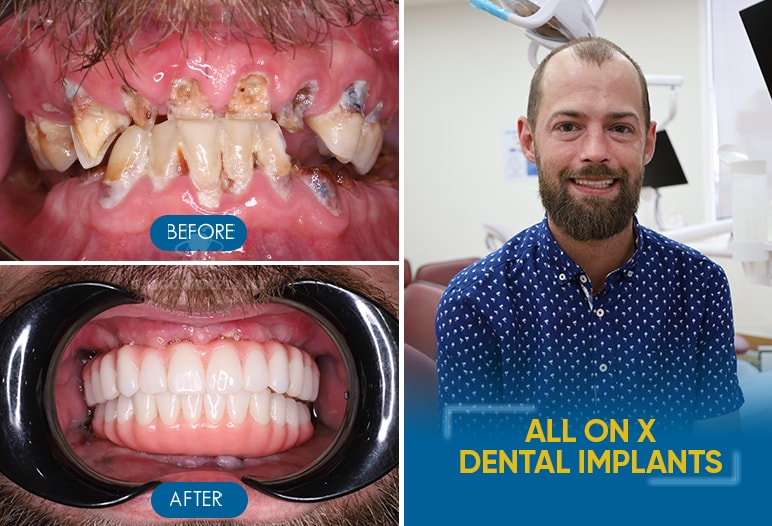 result of dental implants