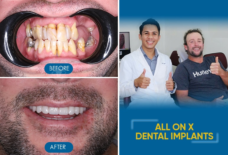 all on 4 dental implants