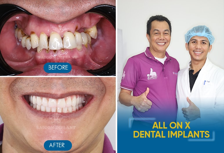 dental implants before after