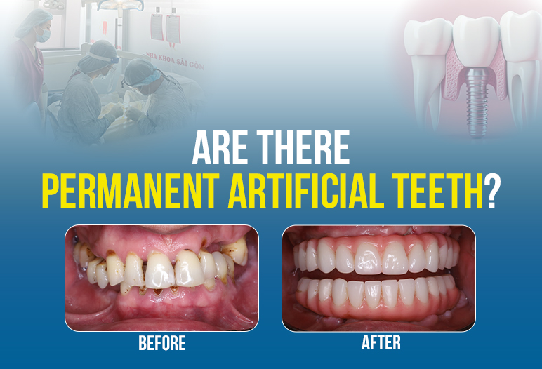 permanent artificial teeth cost