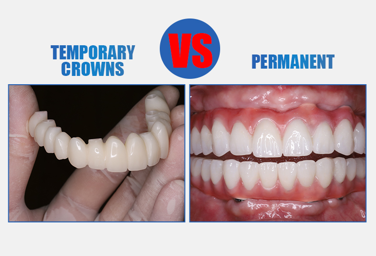 temp crown vs permanent