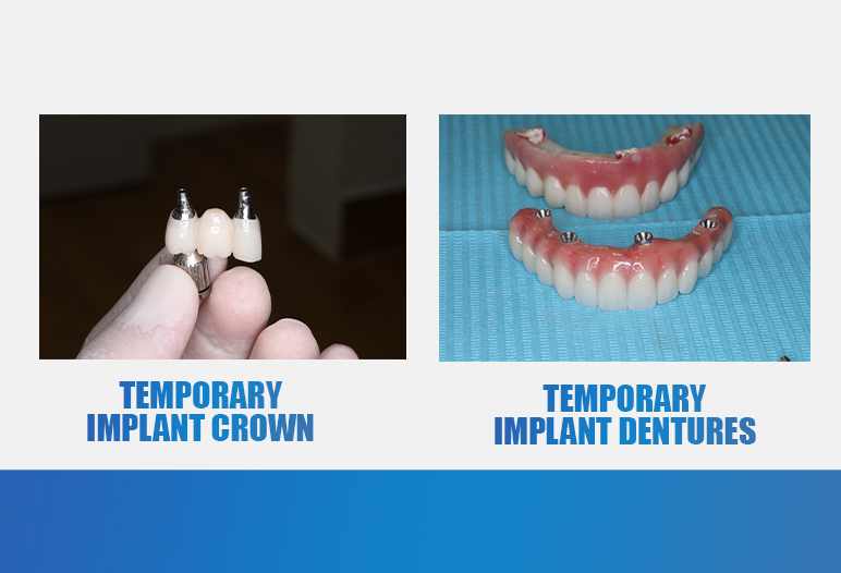 temporary implant crown