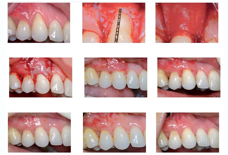 Step-by-step process of gum grafting