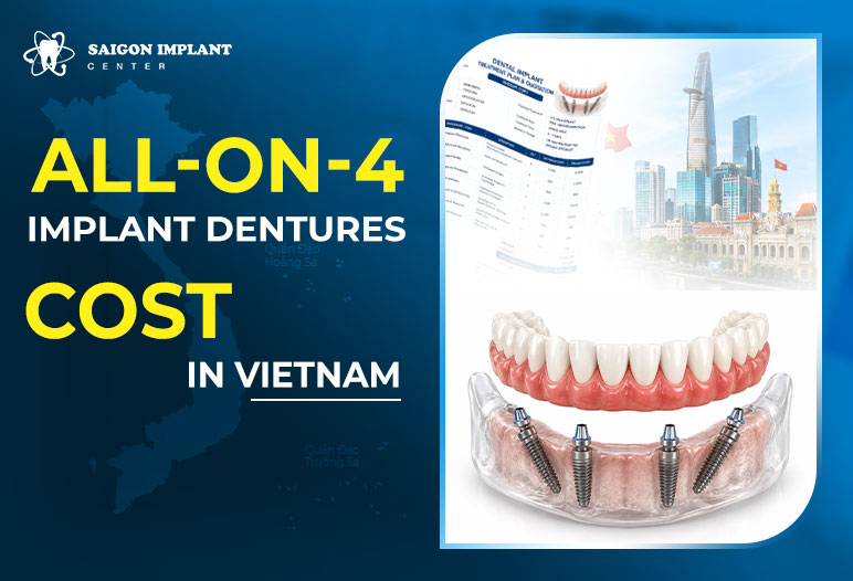 All On 4 Implant Dentures Cost 1 all on 4 implant dentures cost